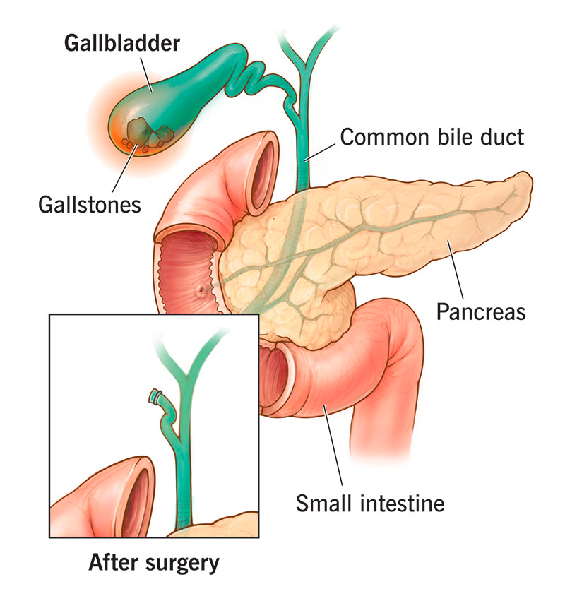 gallbladder removal