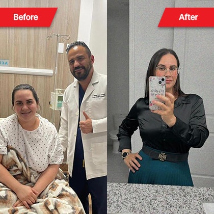 Woman before and after bariatric surgery at Stop Obesity Bariatric Surgery