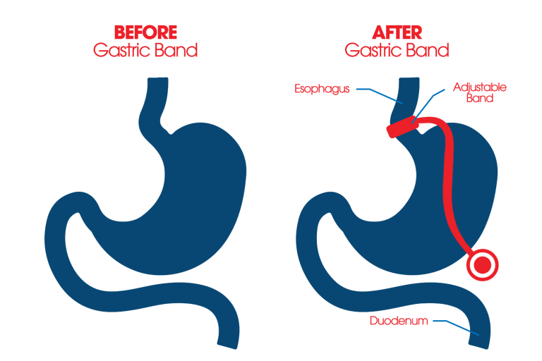 Diagram showing the portion of the stomach removed during gastric sleeve surgery