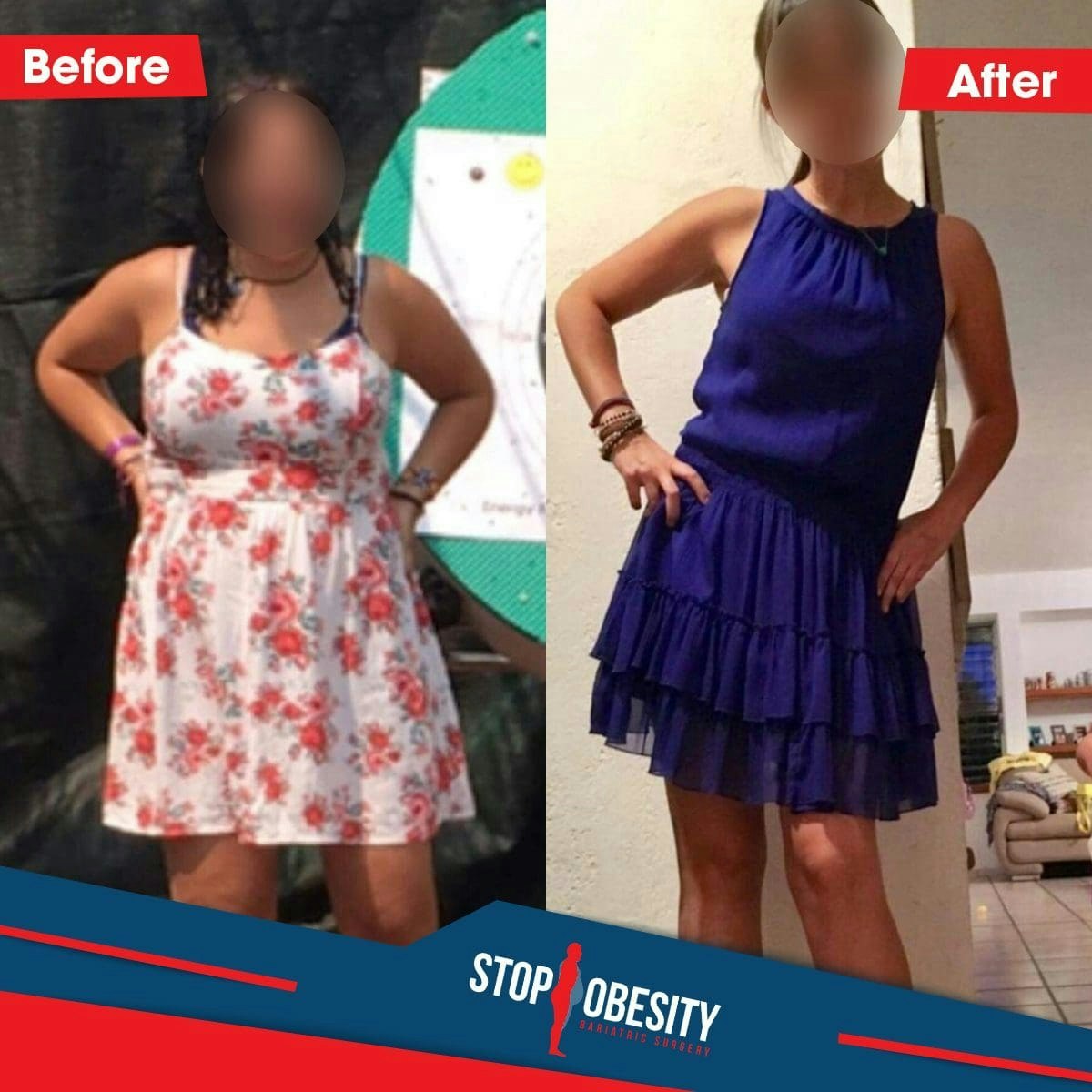 Dr. Ismael Cabrera's patient before and after bariatric surgery