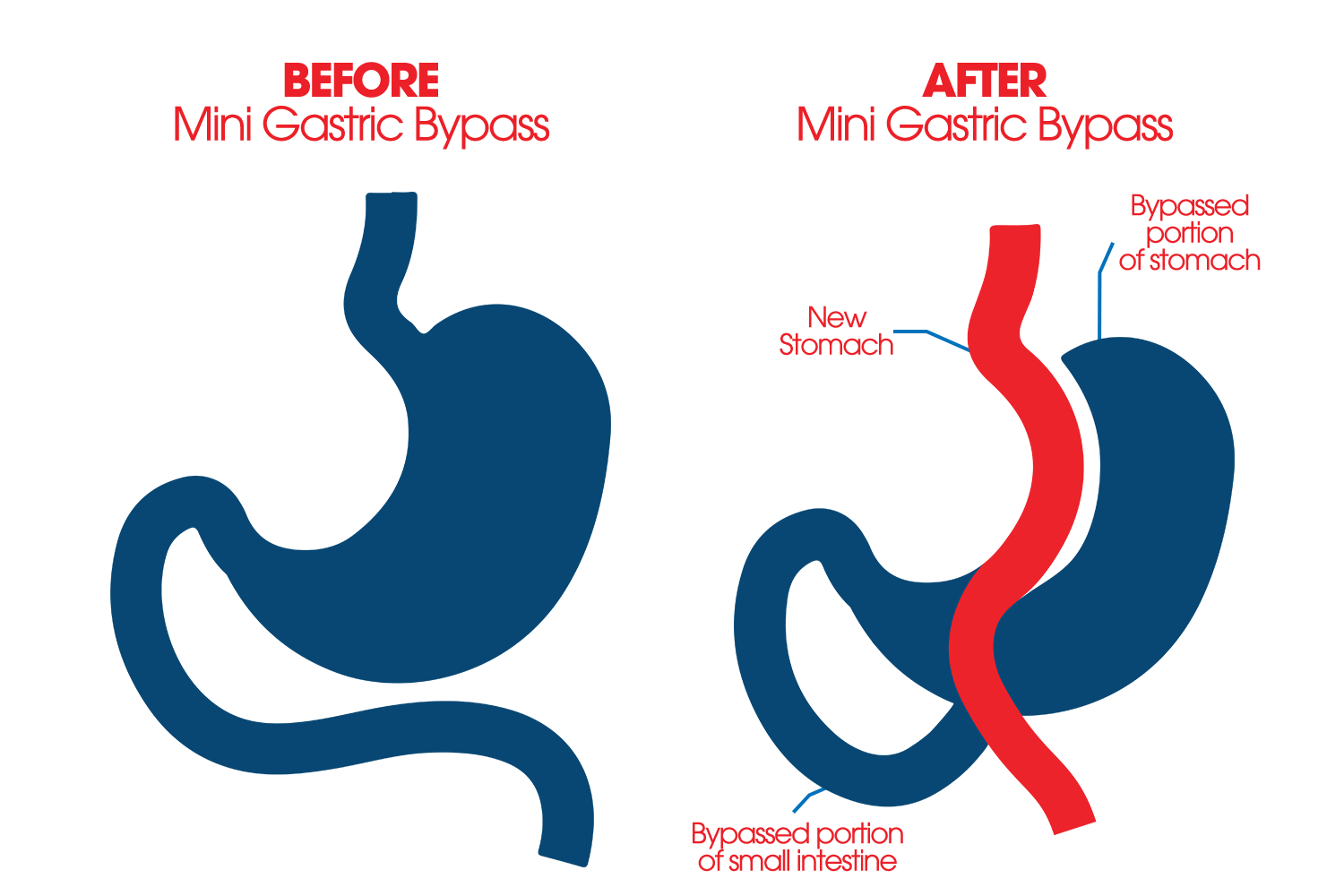 Stomach before and after mini gastric bypass, showing the smaller new pouch and rerouted intestine