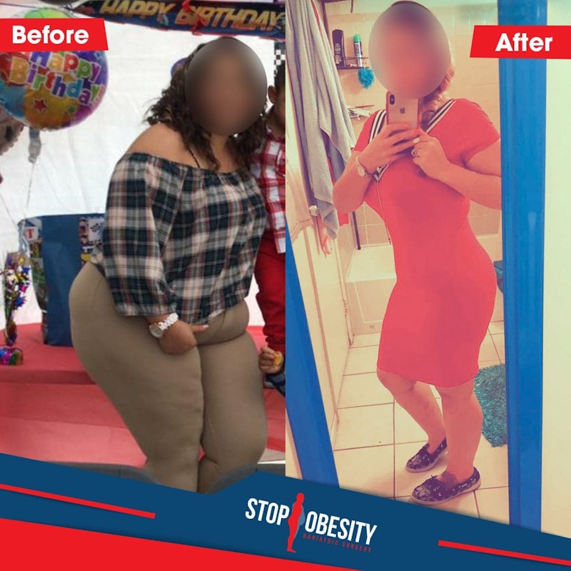 Before and after bariatric surgery
