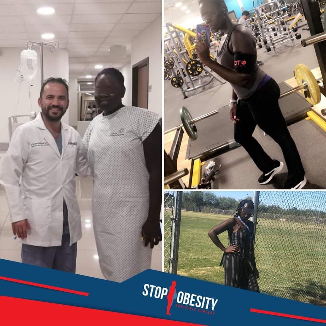 Mini gastric bypass patient showing off weight loss