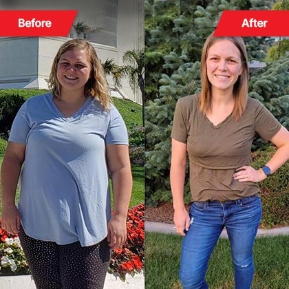 Woman before and after bariatric surgery with Dr. Cabrera