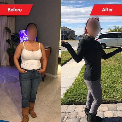 Patient before and after bariatric surgery at Stop Obesity Bariatric Surgery