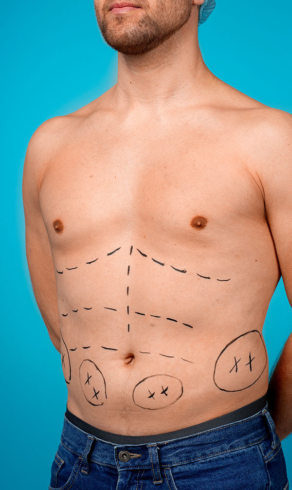 Woman holding hand over stomach after substantial weight loss