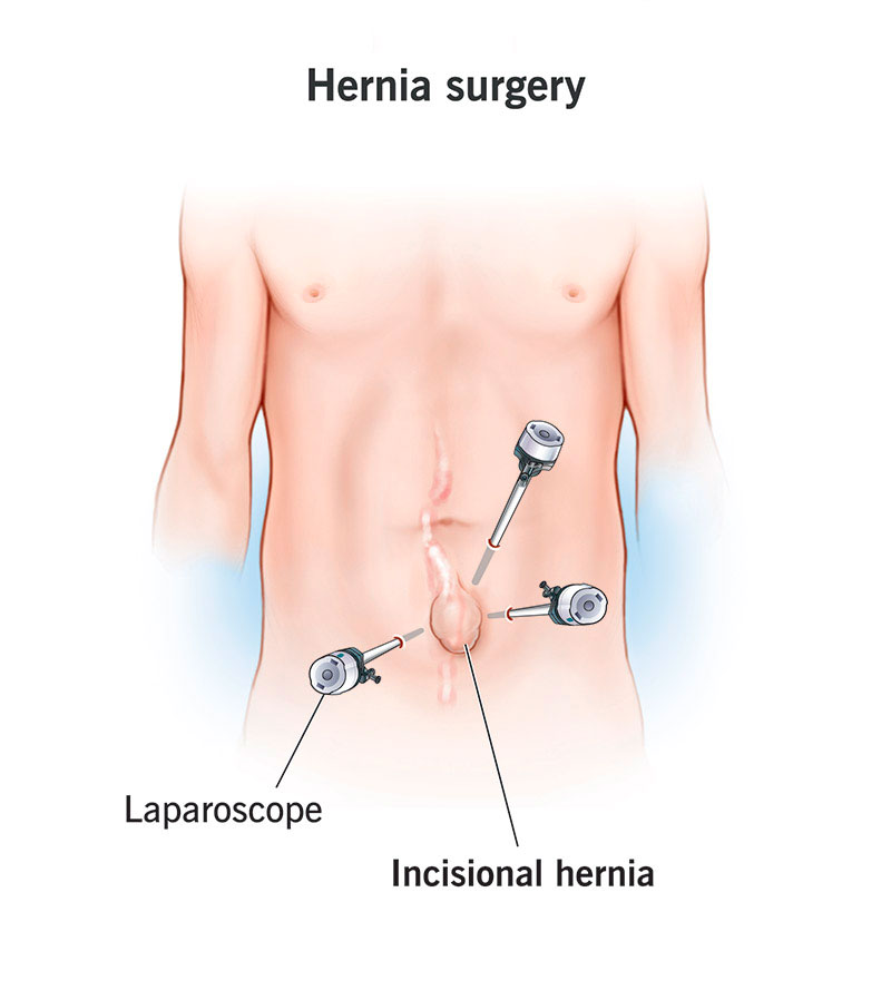 Woman holding hand over stomach after substantial weight loss