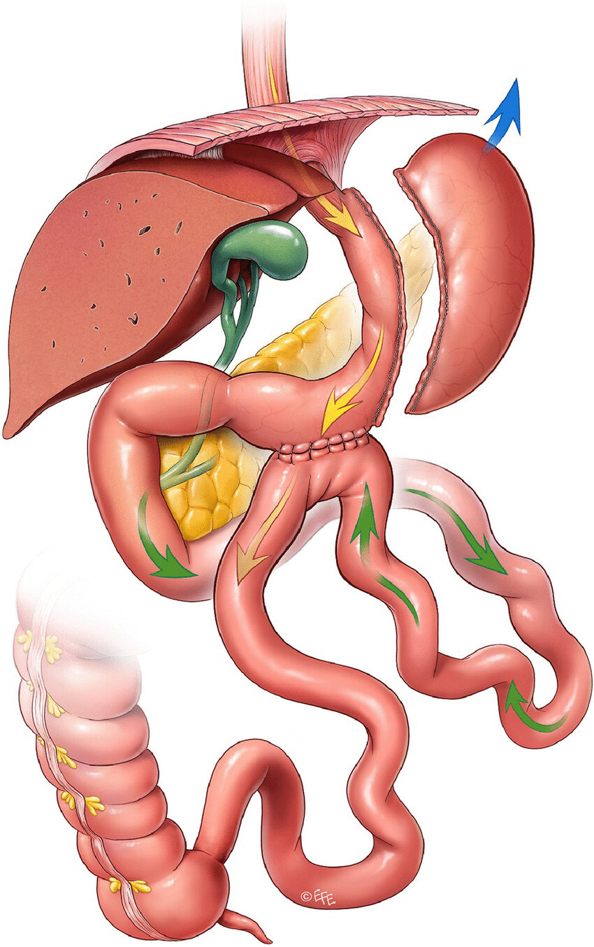 Gastric bypass before and after diagram